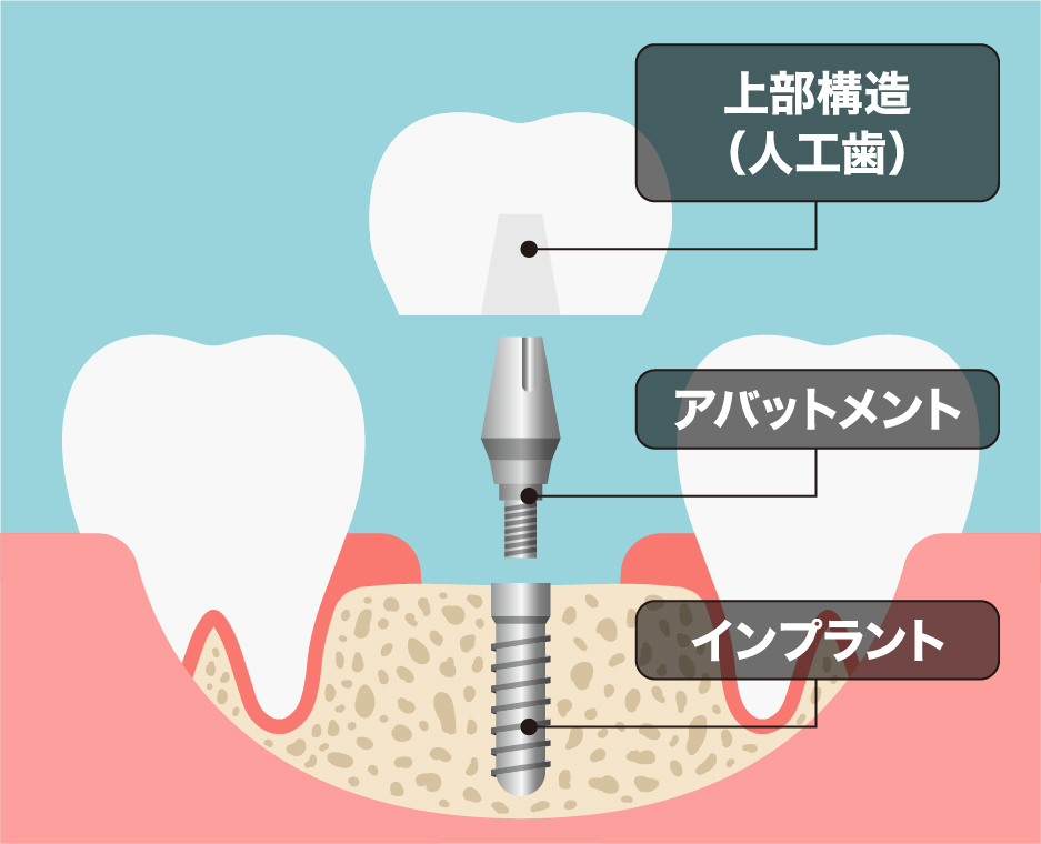 インプラントの構造