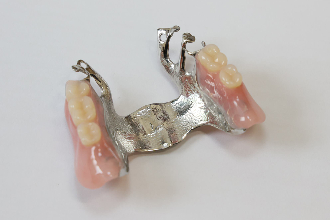 金属床の入れ歯｜野田市のいちファミリー歯科医院