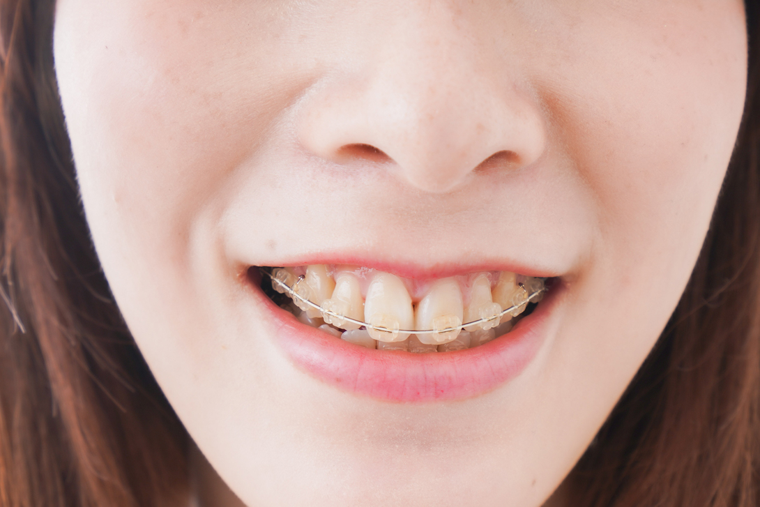 成人矯正｜いちファミリー歯科医院