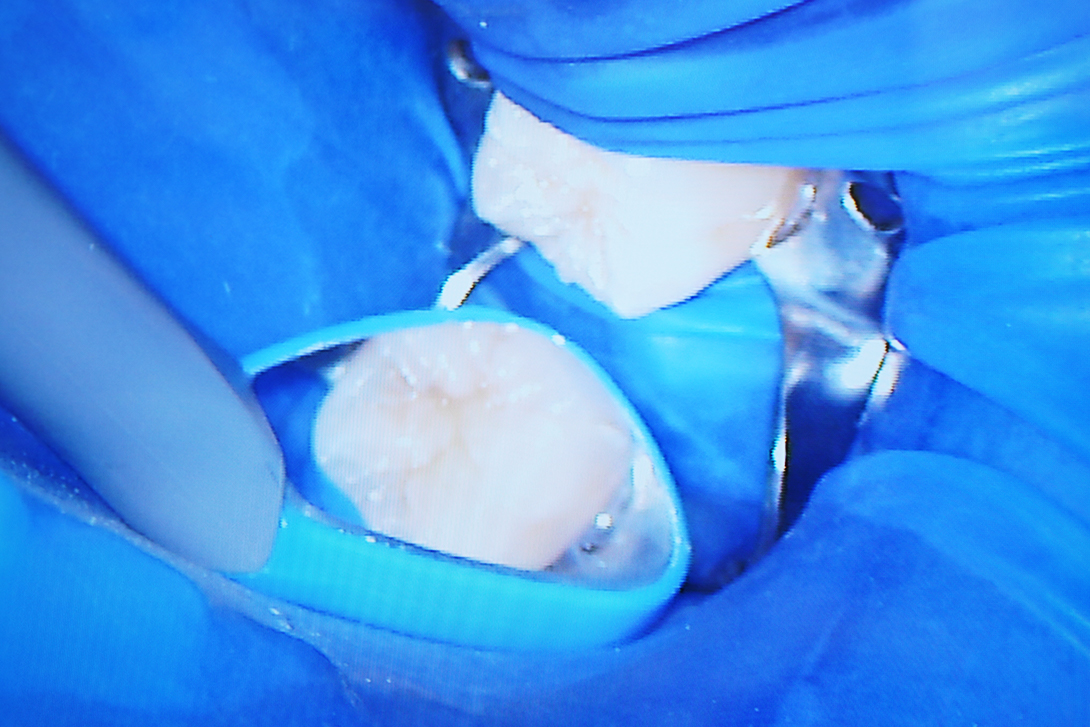 ラバーダム防湿｜野田市のいちファミリー歯科医院