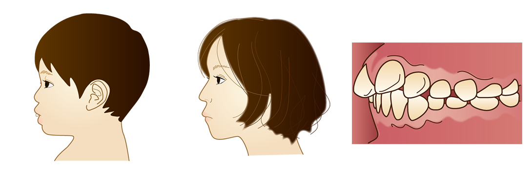 上顎前突（じょうがくぜんとつ）～出っ歯～｜いちファミリー歯科医院