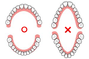 顎の形の変形｜いちファミリー歯科医院