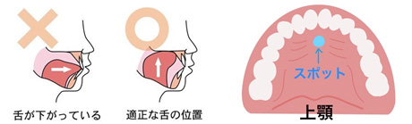 舌癖｜いちファミリー歯科医院